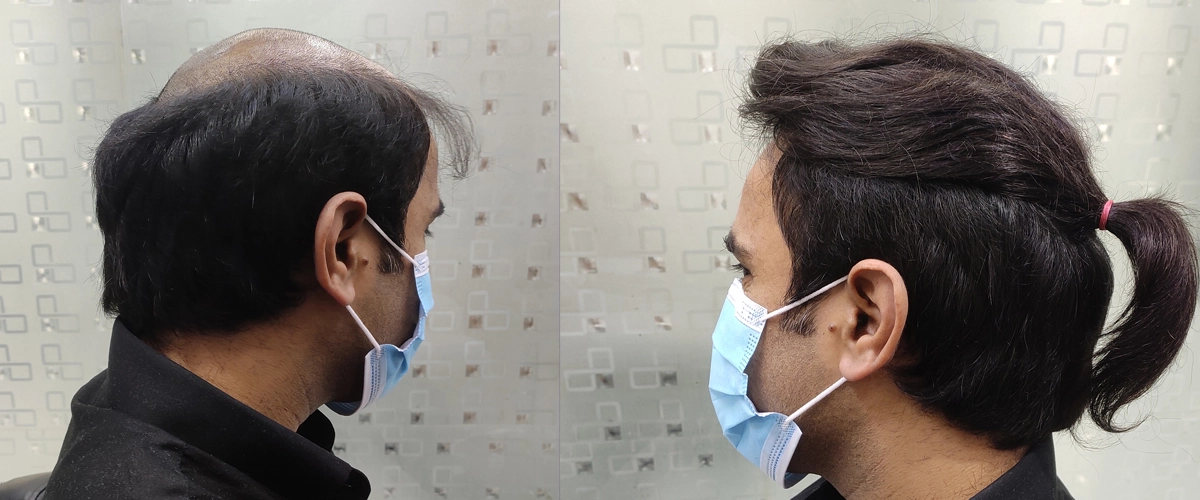 Hair Replacement in Gorakhpur – Ayub Hair Studio’s Trusted Solutions