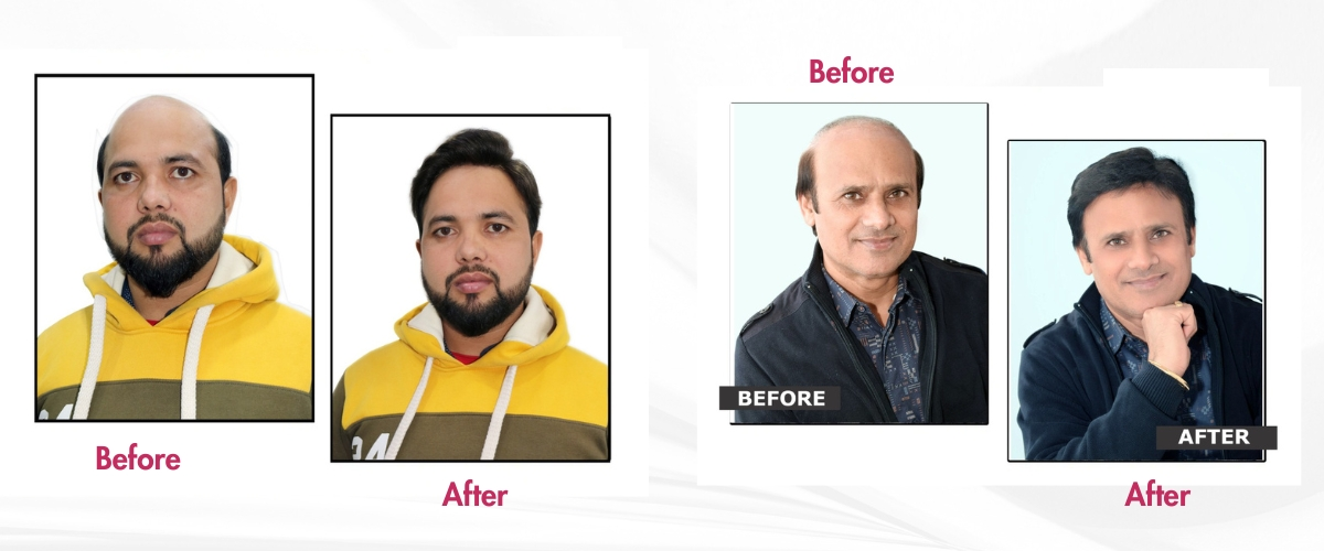Baldness Solution Without Surgery – Ayub Hair Studio’s Non-Invasive Expertise
