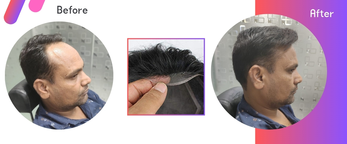 Hair Patch Fixing Near Me – Ayub Hair Studio’s Expert Non-Surgical Solutions
