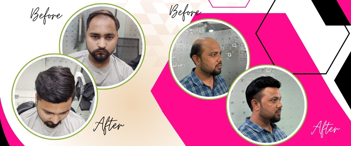 Non Surgical Hair Replacement Near Me – Ayub Hair Studio’s Trusted Hair Solutions
