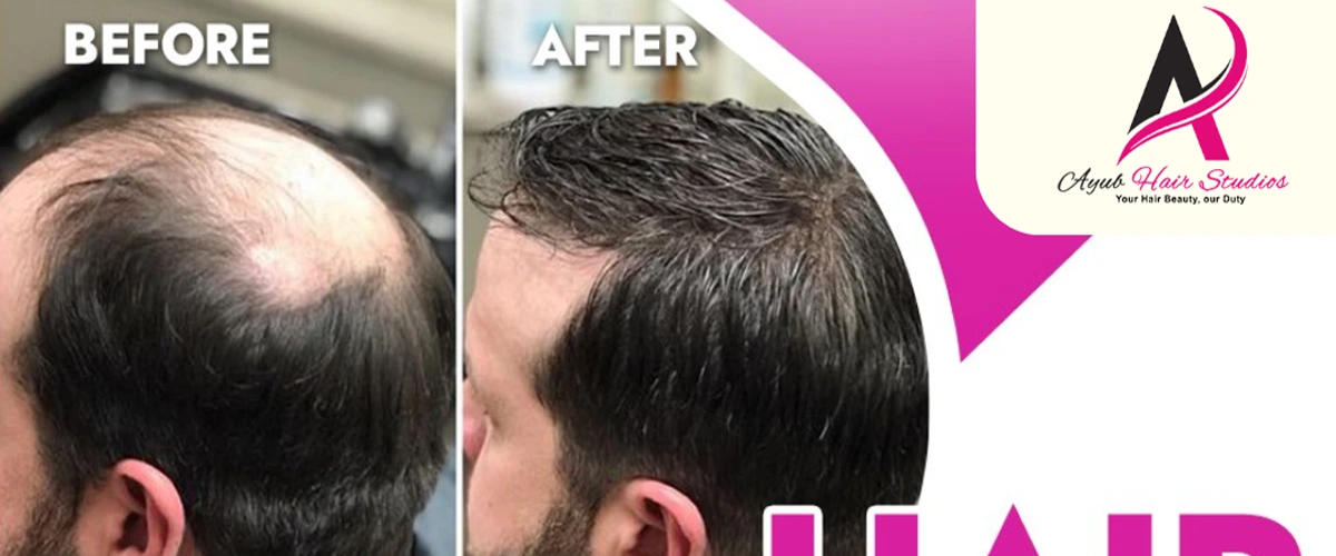 Cover Bald Head Without Transplant – Ayub Hair Studio’s Proven Non-Surgical Solutions