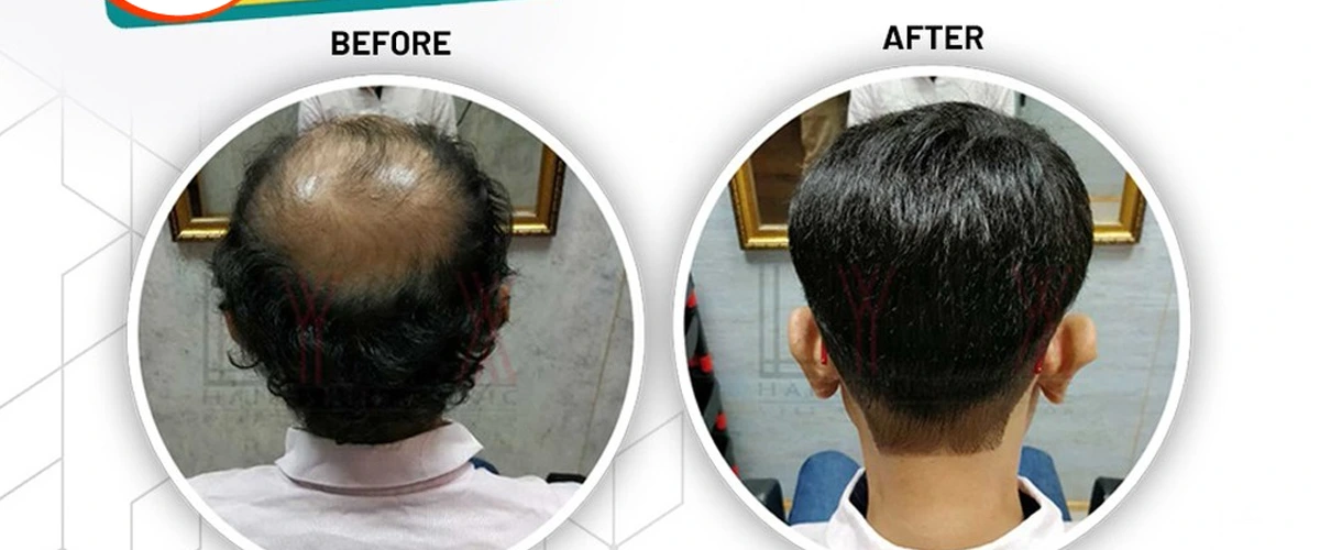 Hair Patch Before and After – Ayub Hair Studio’s Real-Life Transformations